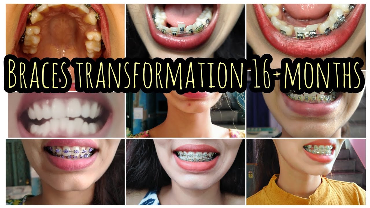 BRACES TIME LAPSE / Braces progress over a year bracespain braces 