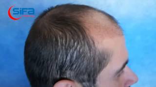 النتائج مضمونة في دار الشفاء لزراعة الشعر للحجز 00905555558555