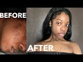 HOW I CLEARED MY ACNE AND HYPERPIGMENTATION | *with pics ( affordable results in 2 weeks)