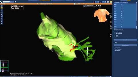Video 10.3 - Interventional Cardiac Electrophysiology