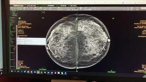 DBT DICOM demo - 3D mammography imaging technique uploaded by nelson wong