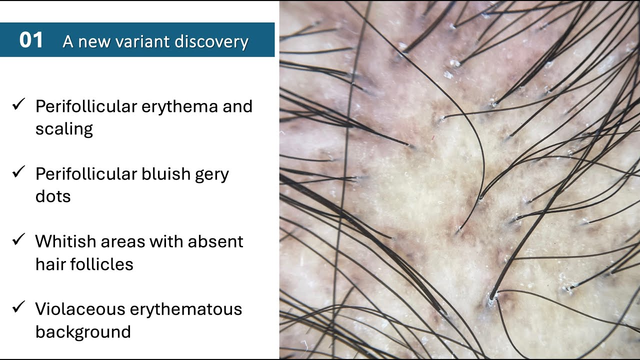 Actinic lichen planopilaris: A newly described variant with case presentation