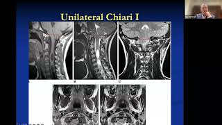 Chiari Over the Ages  Ask the Expert feat. Dr. Gerry Grant