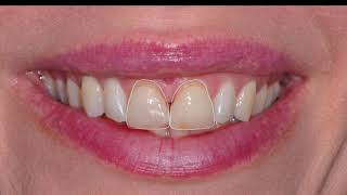 Smile Makeover Options - Everything you need to know with Dr. Faraj Edher
