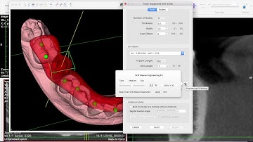 Dental3DPlugin 2.8.0 - Drill Sleeve Engineering Fit