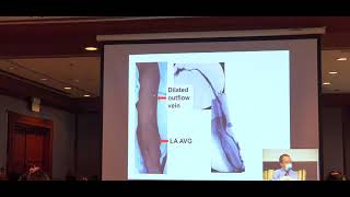 EP.14 Preserve Function of Vascular Access อ.กำธร 12.02.65 screenshot 3