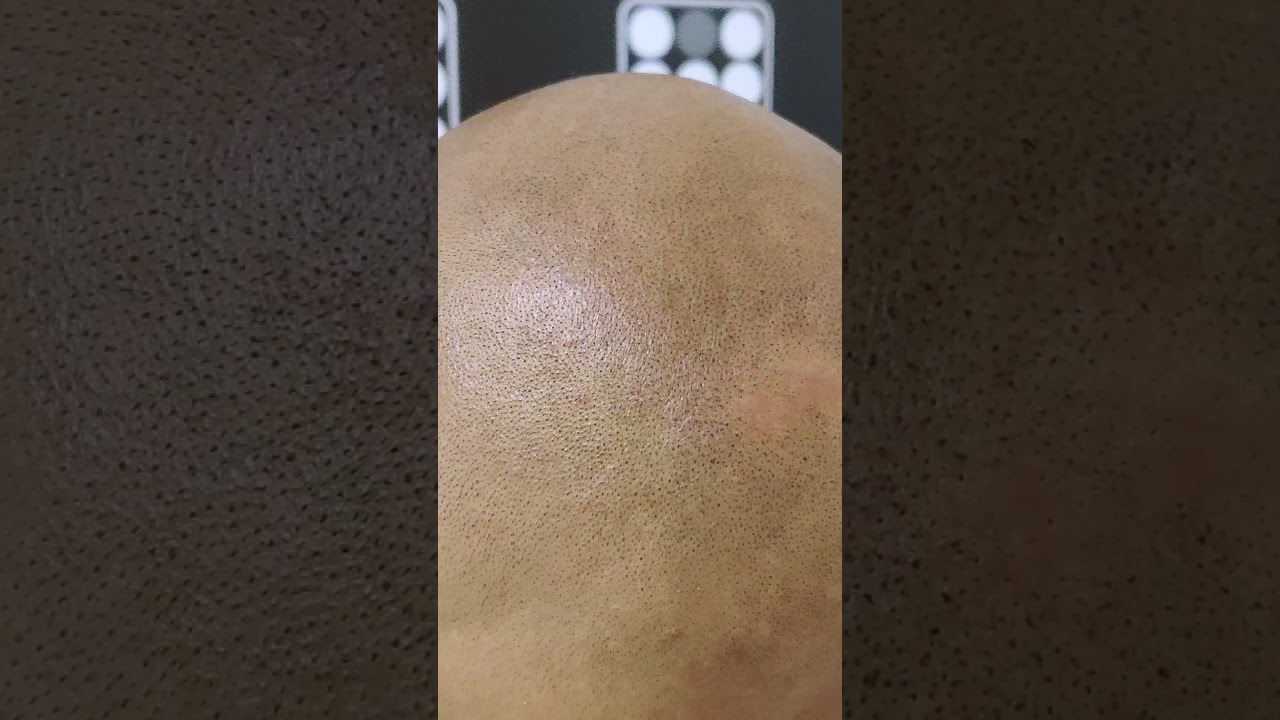 Solutie Chelie Micropigmentare Scalp 