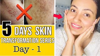 5 DAYS SKIN TRANSFORMATION CHALLENGE : Transformation To a Healthy Glowing & Flawless Skin