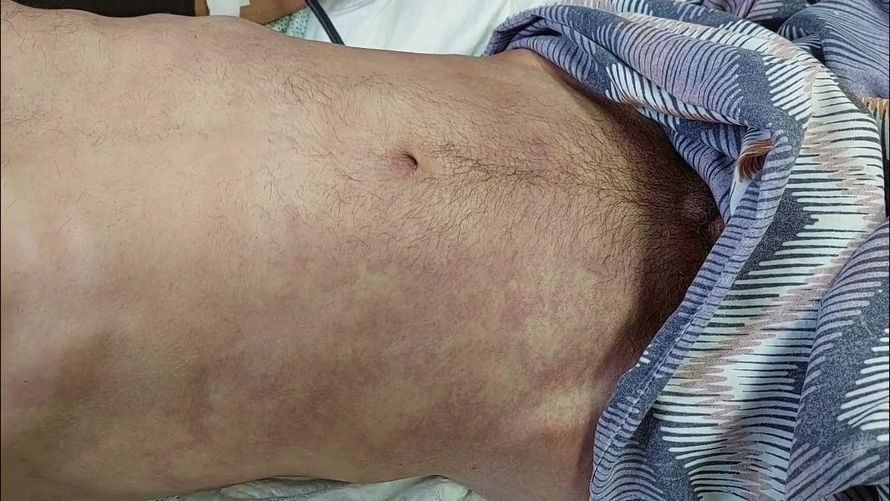 Grey Turner’s Sign. Severe Acute Pancreatitis. Симптом Ґрея Тернера