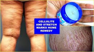 REDUCE CELLULITE AND STRETCH MARKS FAST AND EFFECTIVELY, WITH JUST 3 INGREDIENTS |Khichi Beauty screenshot 5