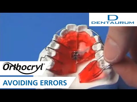 Orthocryl® - tips for avoiding errors on the orthodontic appliance