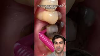 Dentist Explains Viral Cavity