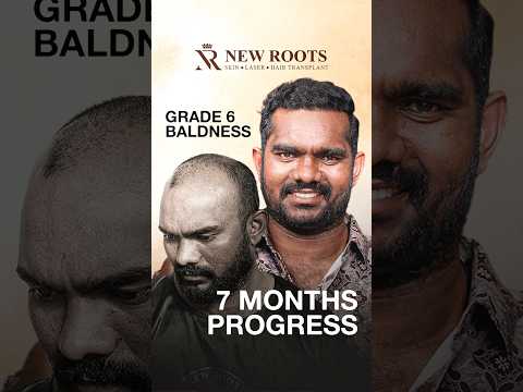 5000 Grafts Hair Transplant in Hyderabad | Grade 6 Baldness #hairtransplant #hyderabad #shorts