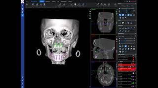 Planning Zygomatic Implants in Romexis 6.1
