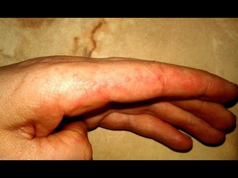 Воспалительные узелки на руках, ногах и других частях тела