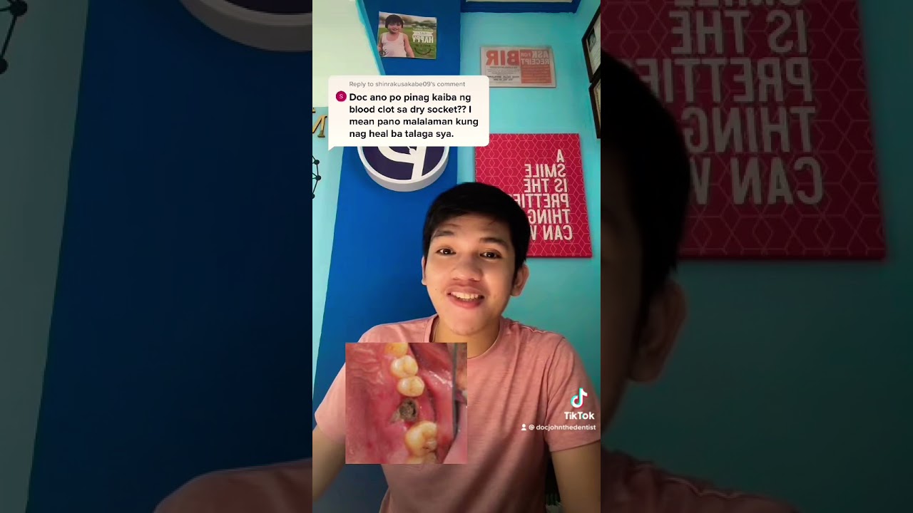 Dry Socket and Blood Clot : Bunot ng Ngipin