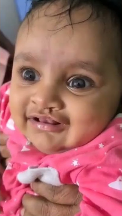 Incomplete Cleft Cutie Gets A Beautiful Face - Cleft Lip Repair In India #shorts
