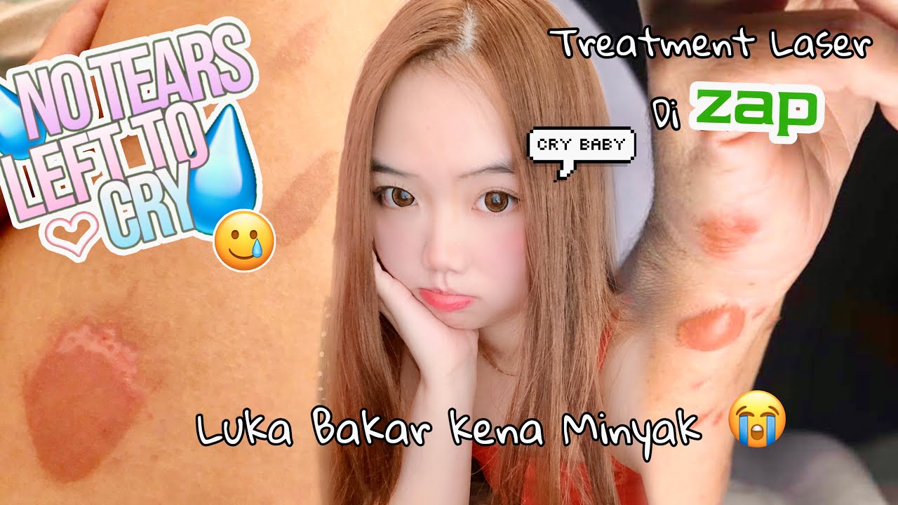 LUKA BAKAR OBAT+ LASER BEKAS LUKA DI ZAP lukabakar zap YouTube