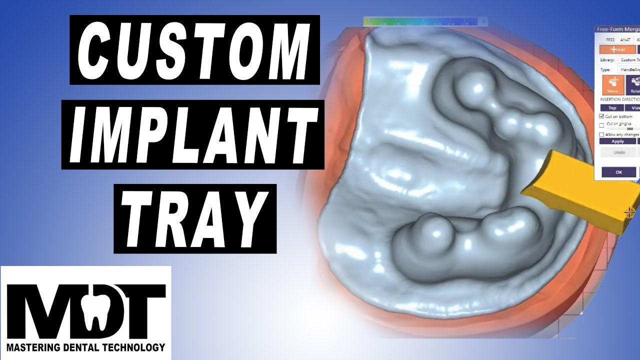 ExoCad custom tray design for open tray impression technique YouTube