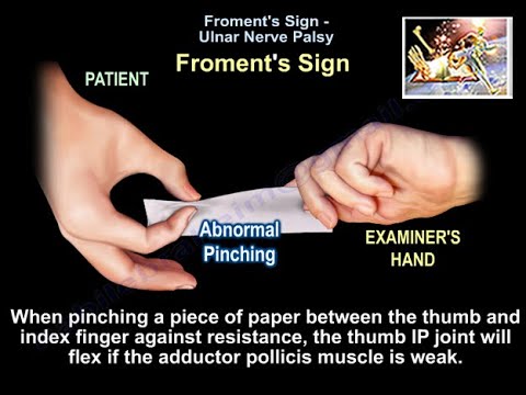Froment's Sign -