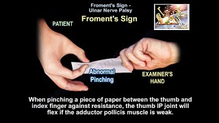 Froment's Sign - Everything You Need To Know - Dr. Nabil Ebraheim