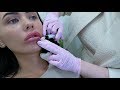 DISSOLVING MY LIP FILLER