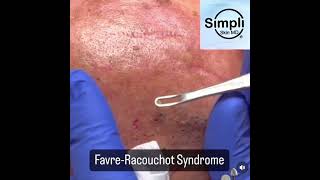 Favre-Racouchot Extraction Spree
