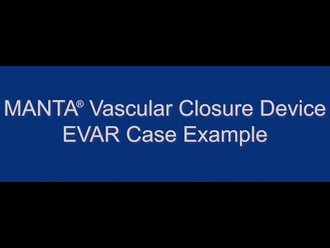 MANTA® Vascular Closure Device EVAR Live Case