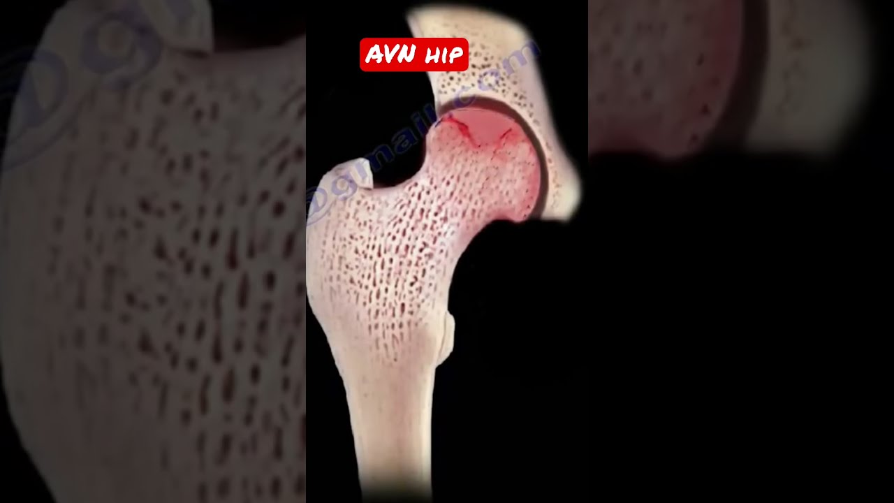 What Is AVN Of The Hip Shorts