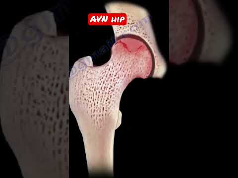 Βίντεο: Είναι η avn ασθένεια;