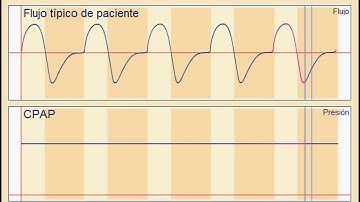 C-Flex de Philips Respironics