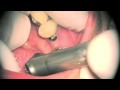 Laser dentistry implant uncovered  lares powerlase at