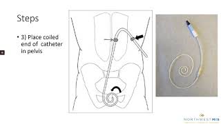 Laparoscopic Peritoneal Dialysis Catheter Placement - for patients