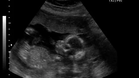 Baby Theresa Mackenzie