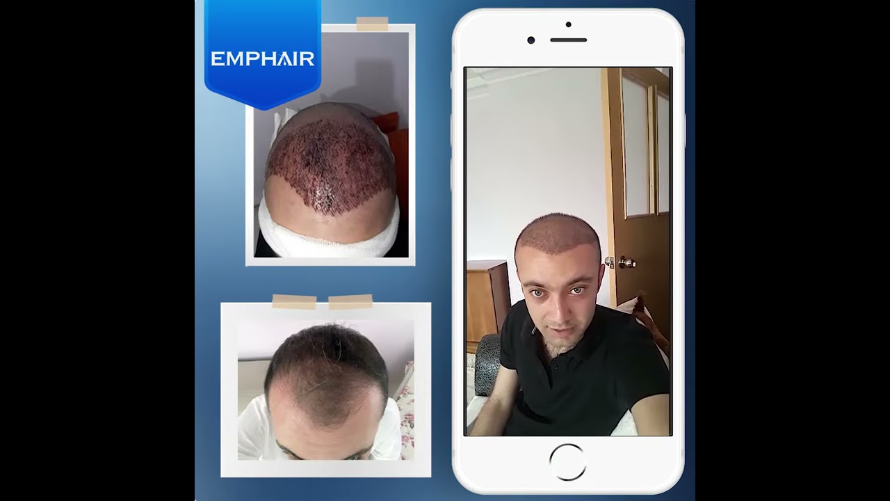 Emphair Hair Transplant Youtube