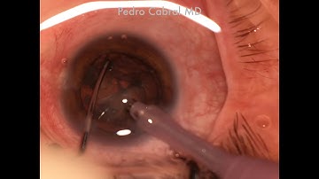 BOWL in the  NUCLEUS in cataract surgery, how to save the surgery ? By Pedro Cabral MD