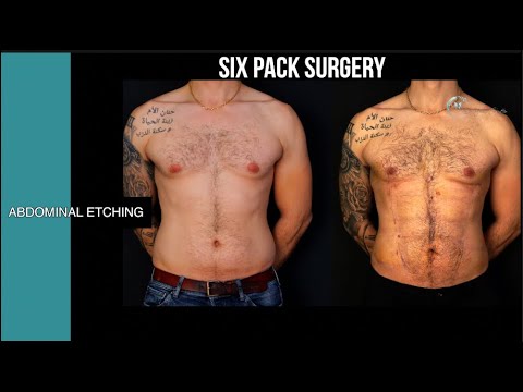 SIX PACK SURGERY |  BEFORE - AFTER |  OP. DR. YUCEL SARIALTIN