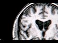 Lingering Neurological Symptoms After COVID-19