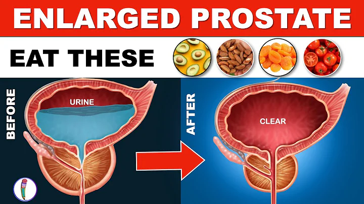 Prostate enlargement Treatment (Naturally) | Benign Prostatic Hyperplasia | Enlarged Prostate Diet - DayDayNews