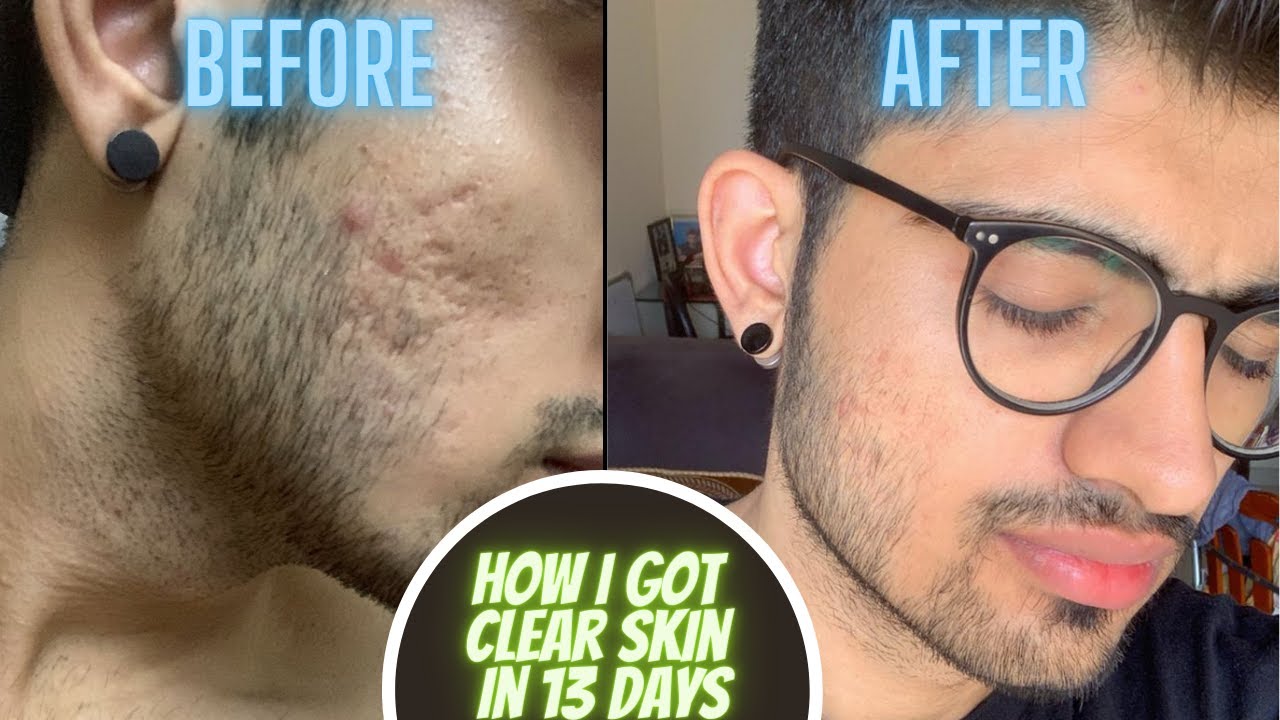 How I got clear skin in 13 days || ULTIMATE SKIN CARE ROUTINE - YouTube