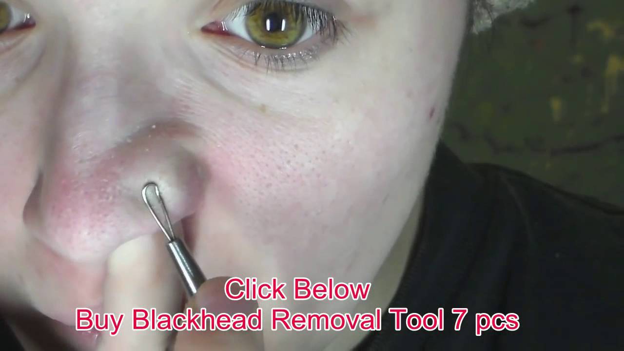 Blackhead Acne Extractor Remover Tool Kit 7pcs Blackhead Acne Comedone ...