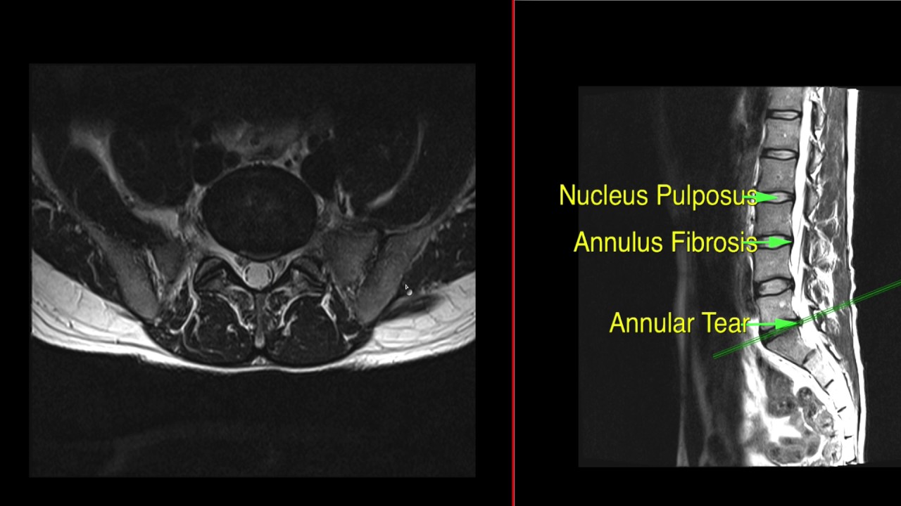 Annular Tear In Lumbar Spine YouTube