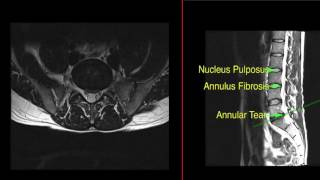 : Annular tear in lumbar spine