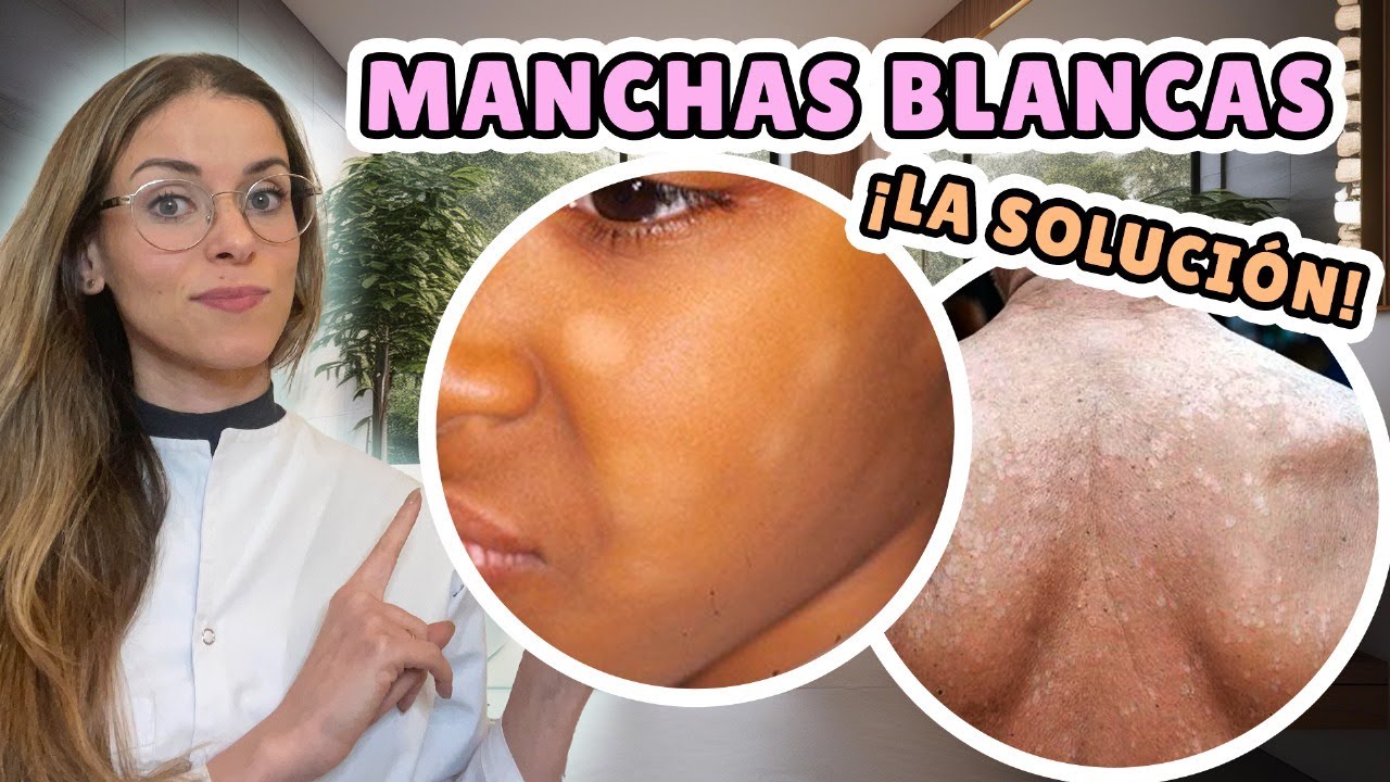 ELIMINA MANCHAS BLANCAS DE TU PIEL | manchas blancas en la piel, la solución definitiva