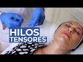 Hilos tensores en cuello  leo cerrud  tcnica 2022