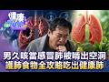 男久咳當感冒！肺被啃出空洞..醫急下令隔離／肺炎盛行率高 護肺食物全攻略..吃出健康肺【57健康同學會】20260627｜張予馨、徐俊相、邱文瑾、吳明珠、江中博