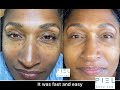 Dermatosis Papulosa Nigra a.k.a DPN Removal 
