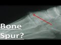 Top of the Foot Bump or Arthritis? *Home Cure*