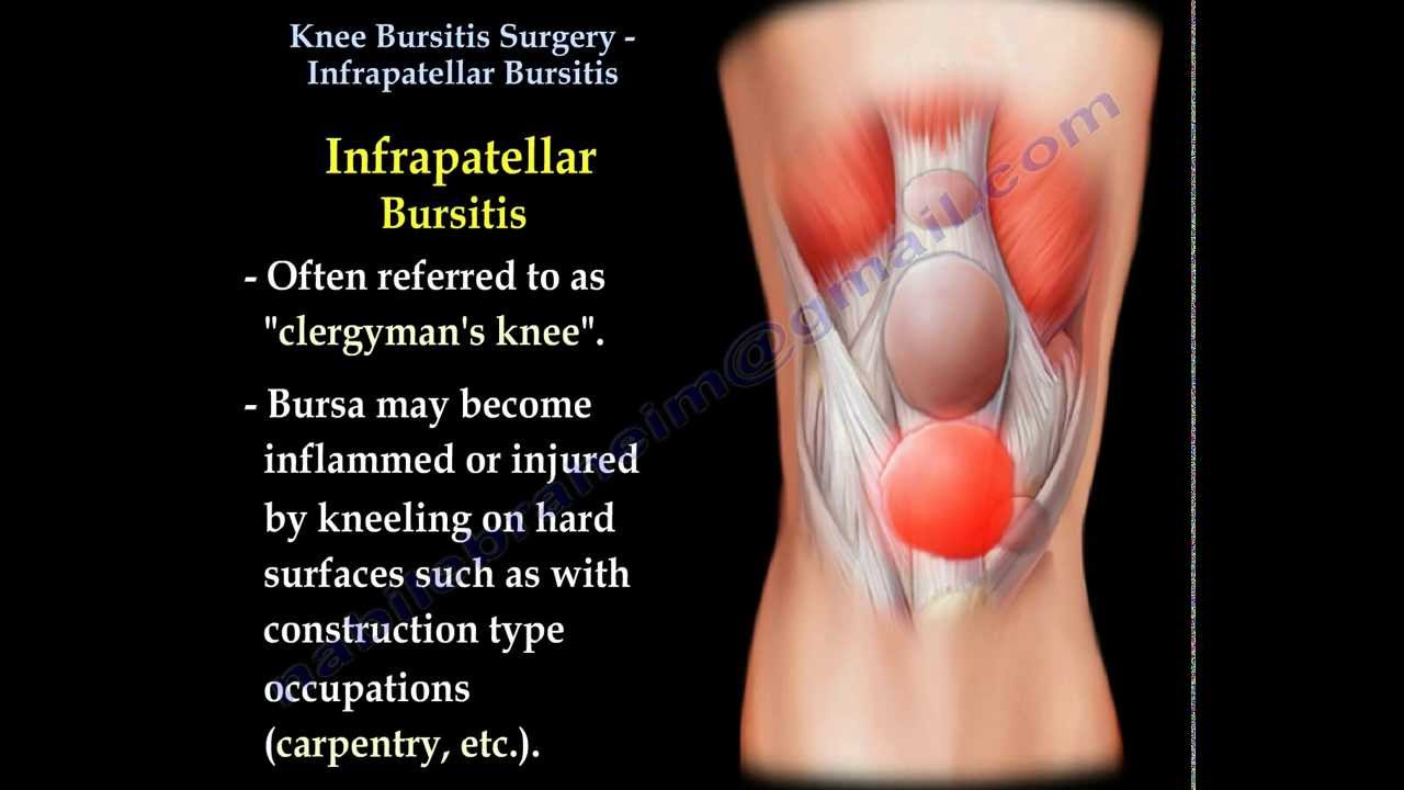 artrózis bursitis térdízület kezelése