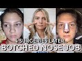 My Botched Nose Job | 4 SURGERIES